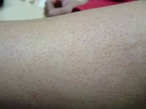 White Bumps On Face And Upper Arms
