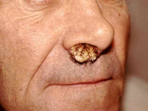 Warts On Body
