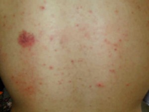What You should Know About Ringworm - WebMD