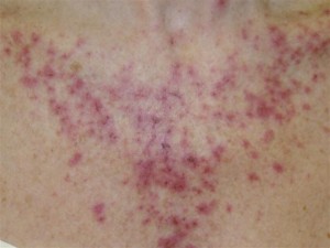 Actinic Keratosis - The Skin Center: Board-Certified ...