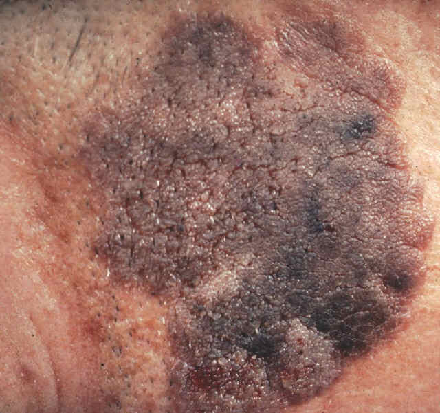 Black Mole On Dog Skin