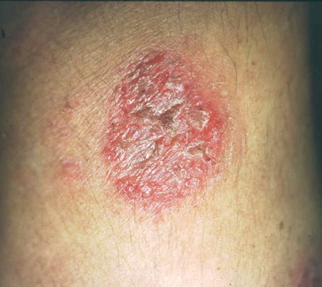 What are non-itchy and peeling skin rashes all over the body?