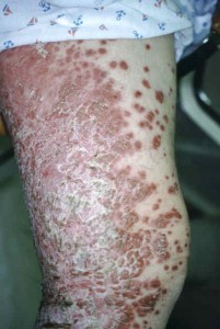 Folliculitis caused by steroid cream