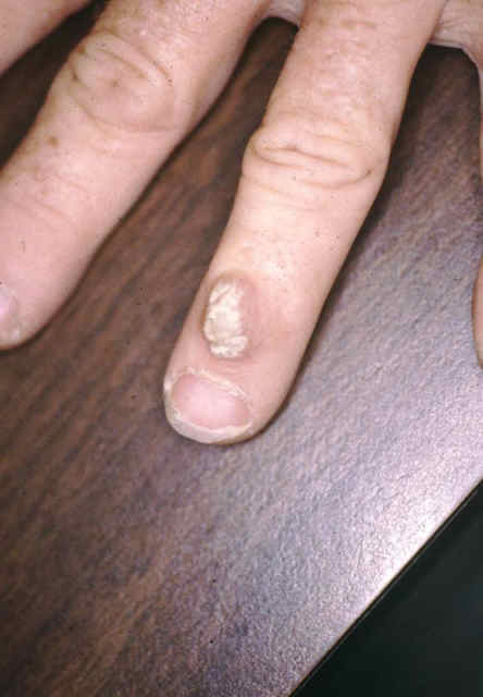 Hand Warts & Finger Warts Pictures - Amoils.com